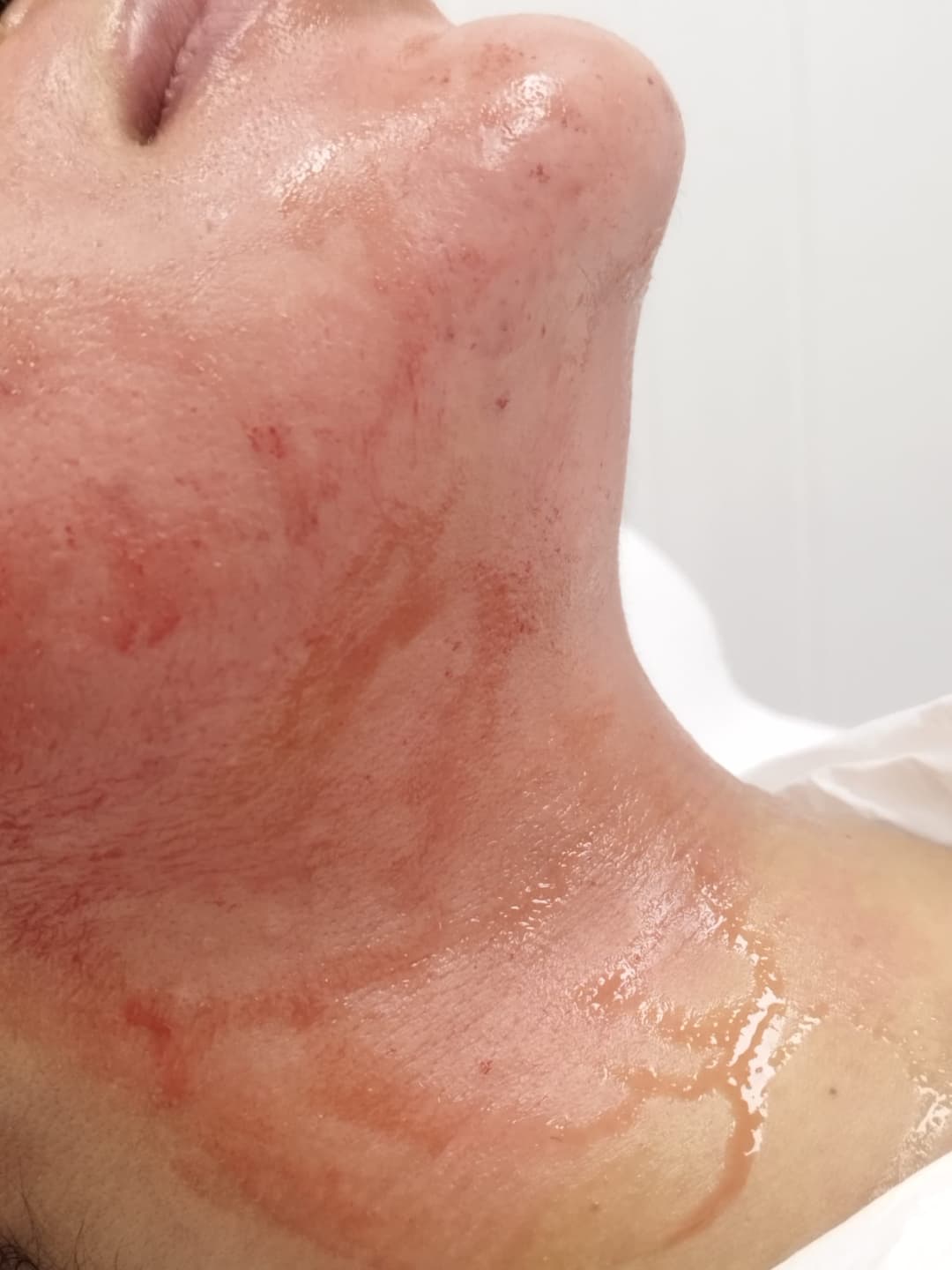 Gallery image - Microneedling