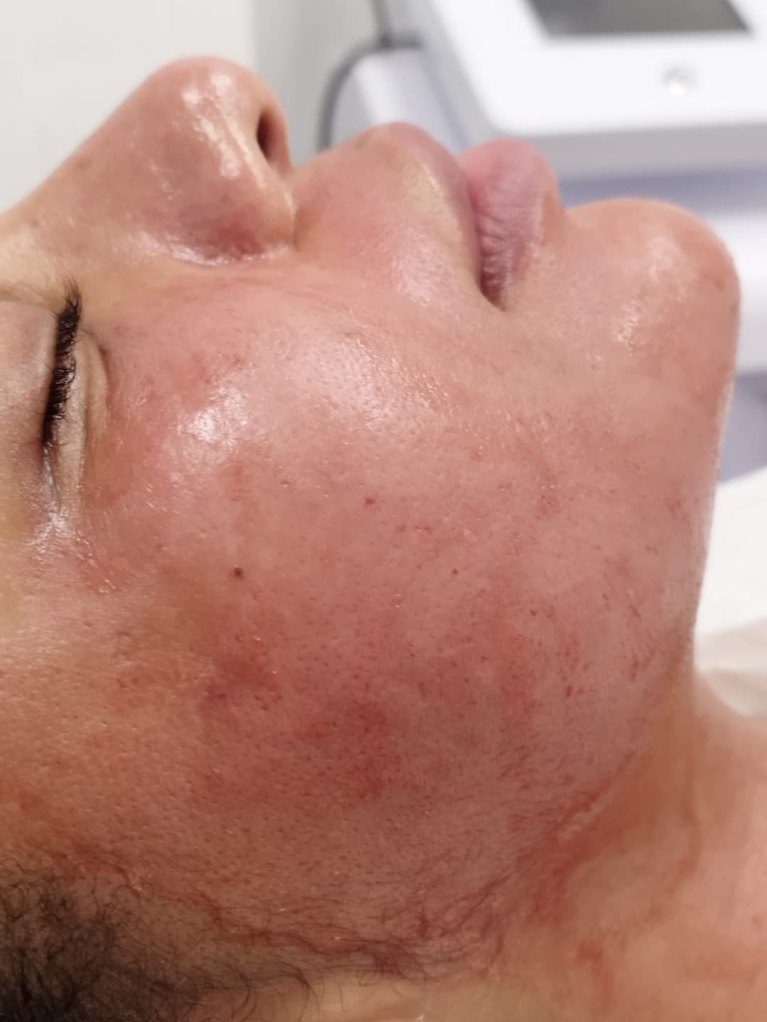 Gallery image - Microneedling