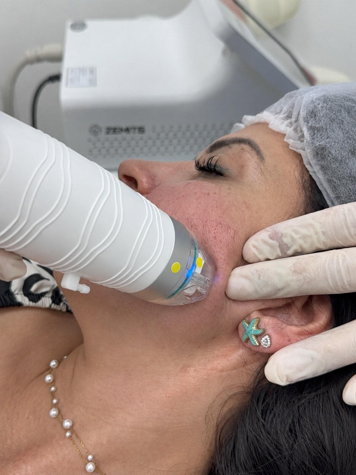 RF Microneedling treatment