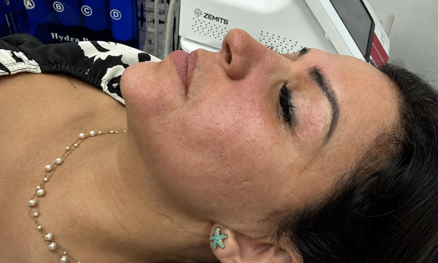 RF Microneedling at Panacea Health and Beauty Clinic